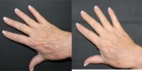 55-64 year old woman treated with Hand Rejuvenation
