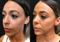 25-34 year old woman treated with Juvederm Filler Injections for Lip Augmentation