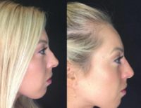25-34 year old woman treated with Non Surgical Nose Job