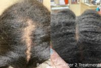 Woman treated with PRP for Hair Loss