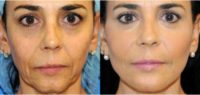 45-54 year old woman treated with Injectable Fillers and Laser Skin Tightening