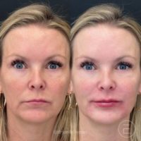 45-54 year old woman treated with Restylane Kysse