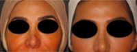 35-44 year old woman treated with Injectable Fillers for non surgical nose job