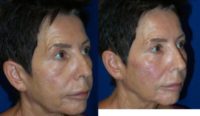 55-64 year old woman treated with Restylane Lyft