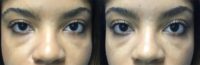25-34 year old woman treated with a Lash Lift