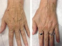 55-64 year old woman treated with Radiesse for hand rejuvenation