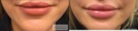 25-34 year old woman treated with Juvederm - mini lip fill