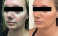 Woman treated with Non Surgical Face Lift