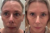 39 year old woman treated with Botox and Filler