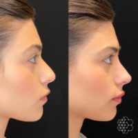 25-34 year old woman treated with Dermal Fillers