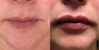 45-54 year old woman treated with Restylane Silk