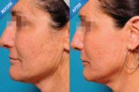 Woman treated with Halo Laser