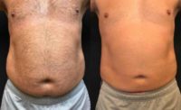 CoolSculpting & SculpSure [Fire & Ice] Results from 1 Session