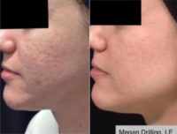 25-34 year old woman treated with Halo Laser