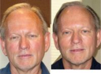 65-74 year old man treated with Non Surgical Face Lift