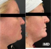 45-54 year old woman treated with IPL, Skin Rejuvenation