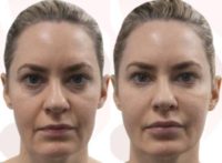 35-44 year old woman treated with Nonsurgical Facelift