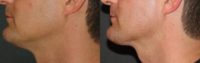 25-34 year old man treated with Kybella