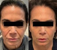 Woman treated with Sculptra