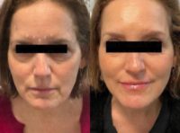 Woman treated with Sculptra