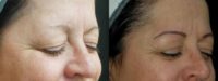 Treated with Microblading
