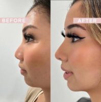 Woman treated with Chin Filler, Nonsurgical Nose Job