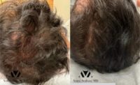 Man treated with PRP for Hair Loss