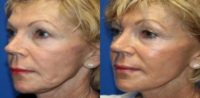 Skin Tightening-Scarlet - RF Microneedling Face Rejuvenation