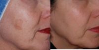 45-54 year old woman treated with Age Spots Treatment