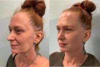 45-54 year old woman treated with Botox, Juvederm, Restylane and PDO threadlift