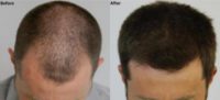 3,000 graft FUE Hair Restoration
