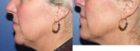 Juvederm to define jawline and lift/enhance cheeks