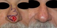 55-64 year old man treated with Mohs Surgery on the nose