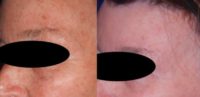 55-64 year old woman treated with IPL for facial brown spots