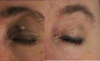 45-54 year old woman treated with Mole Removal