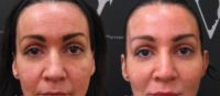 Facial fillers for a fresher, younger look