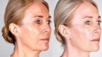45-54 year old woman treated with Ultherapy