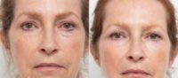 65-74 year old woman treated with Liquid Facelift