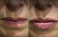 45-54 year old woman treated with Juvederm