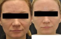 Facial Aging Grooves
