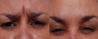 Female Treated for Forehead Wrinkles