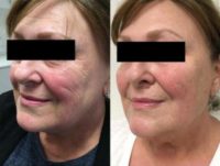 Woman treated with Non Surgical Face Lift