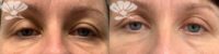 Woman treated with Upper Blepharoplasty