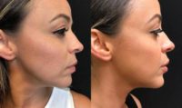 Juvederm Lip Filler for Hispanic Woman in her 30's
