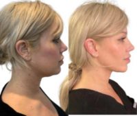 Woman treated with Chin Filler