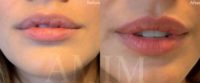 Woman treated with Lip Fillers