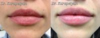 Lip aumentation
