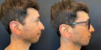 Man treated with Chin Filler