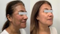 Woman treated with Clear and Brilliant