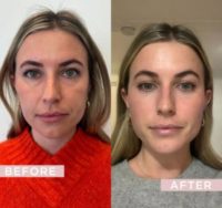 Woman treated with Contour Thread Lift